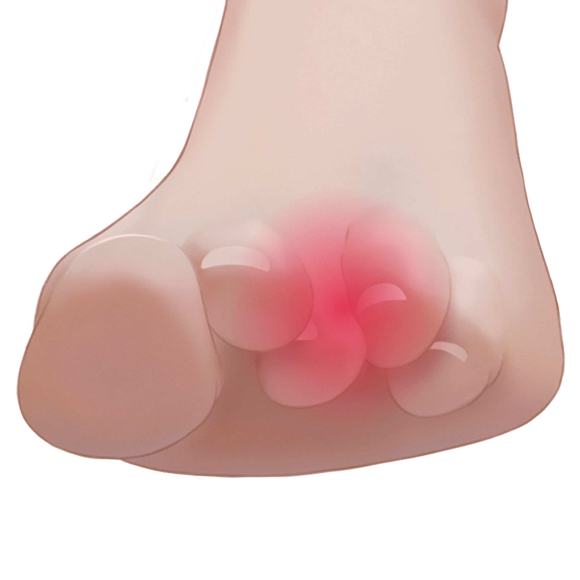 Corrector de Dedos em Garra Gel - Deramed