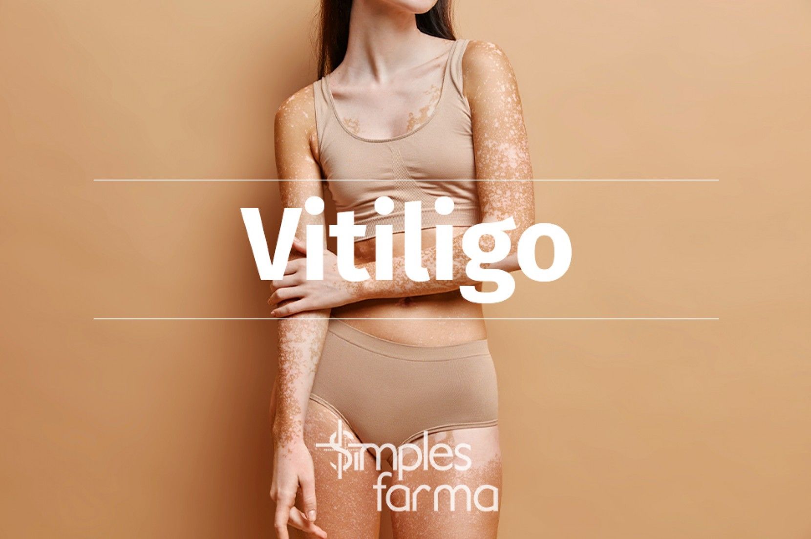 Vitiligo
