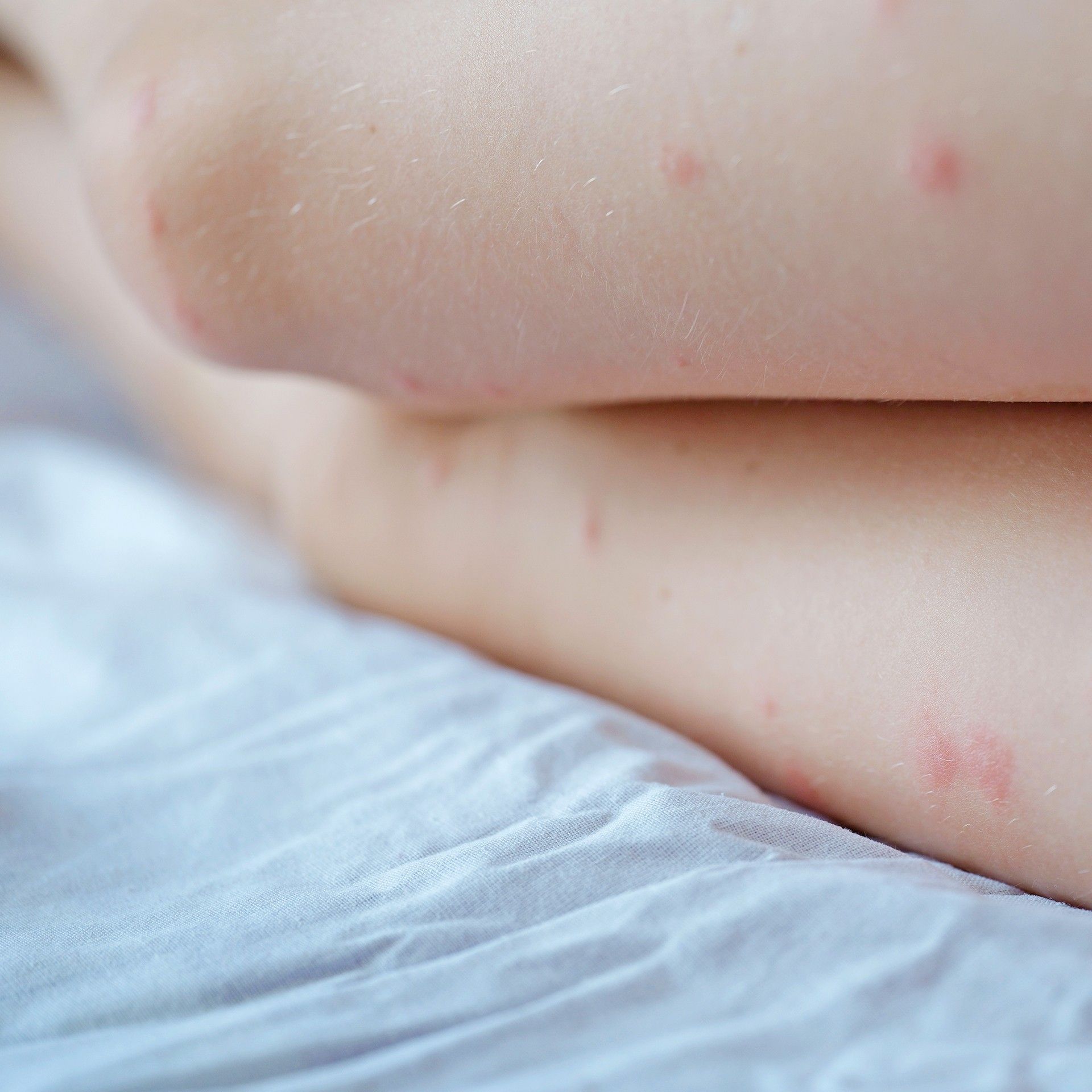 Terapharma Alerpik Gel 50 ml